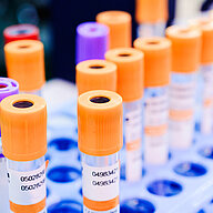 Orange- and purple capped sample tubes arranged in a laboratory rack.